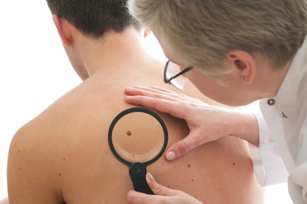 controllo nei prima di prendere il sole per evitare melanoma