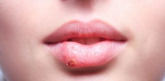 Rimedi naturali contro herpes labiale