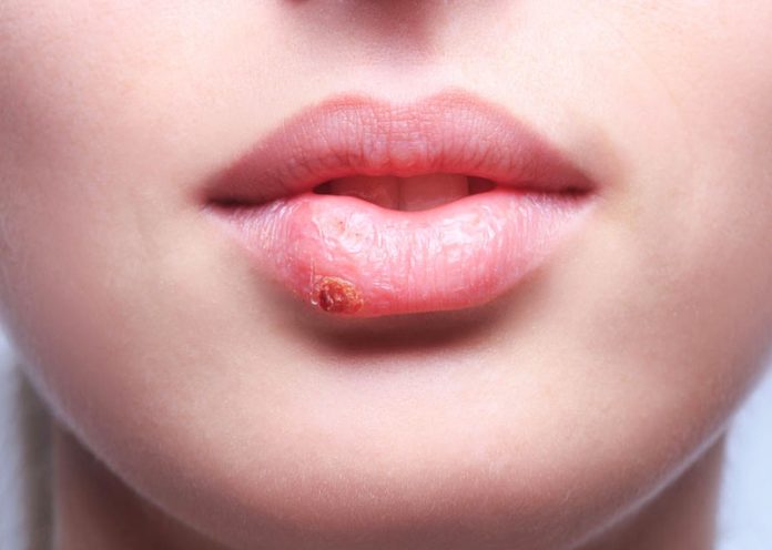 Rimedi naturali contro herpes labiale