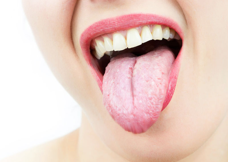 15 stati di alterazione della lingua (colore e forma) che è bene non sottovalutare