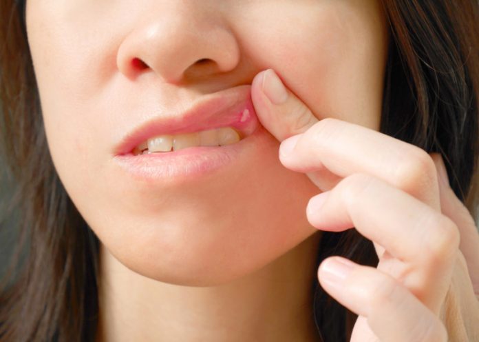 Mani-bocca-piedi, un virus che può colpire anche i genitori