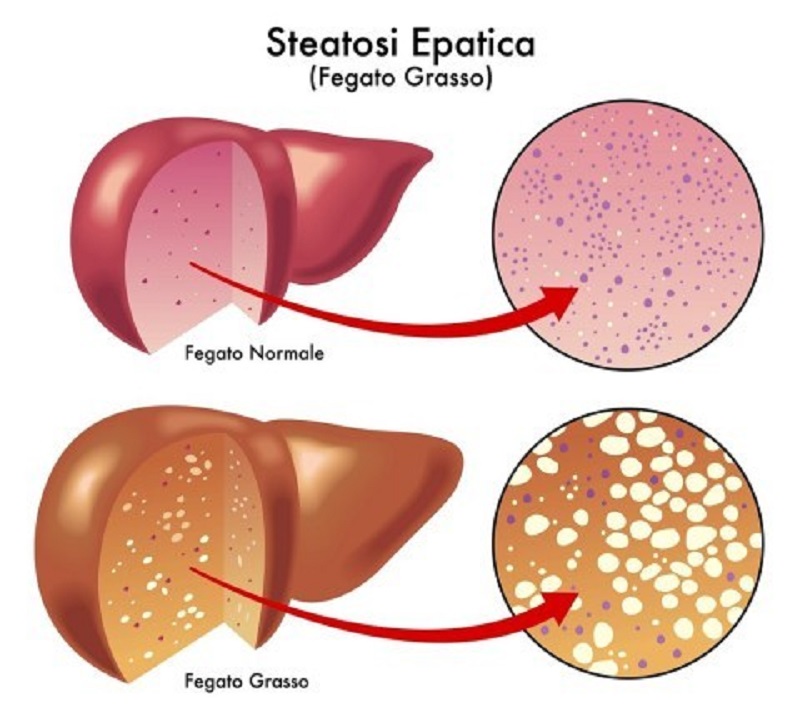 steatosi epatica, fegato grasso