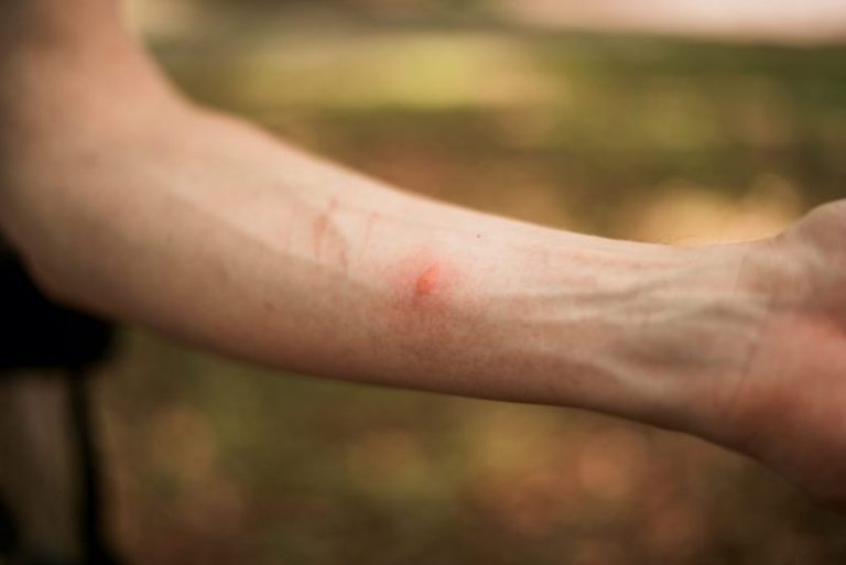 Puntura di ape o vespa, i rimedi naturali per alleviare il dolore