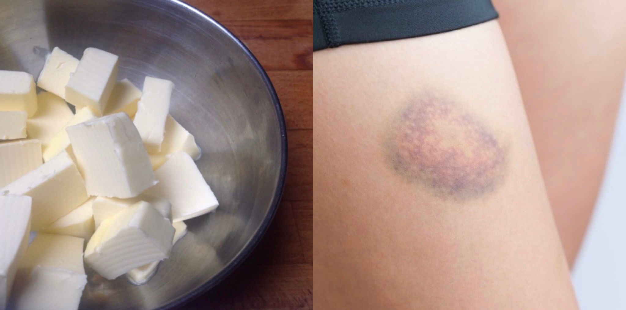 In Caso Di Bernoccoli O Lividi Il Miglior Rimedio Naturale E Il Burro Benessere Alimentazione Sana Prodotti Bio E Rimedi Naturali Soluzionibio It