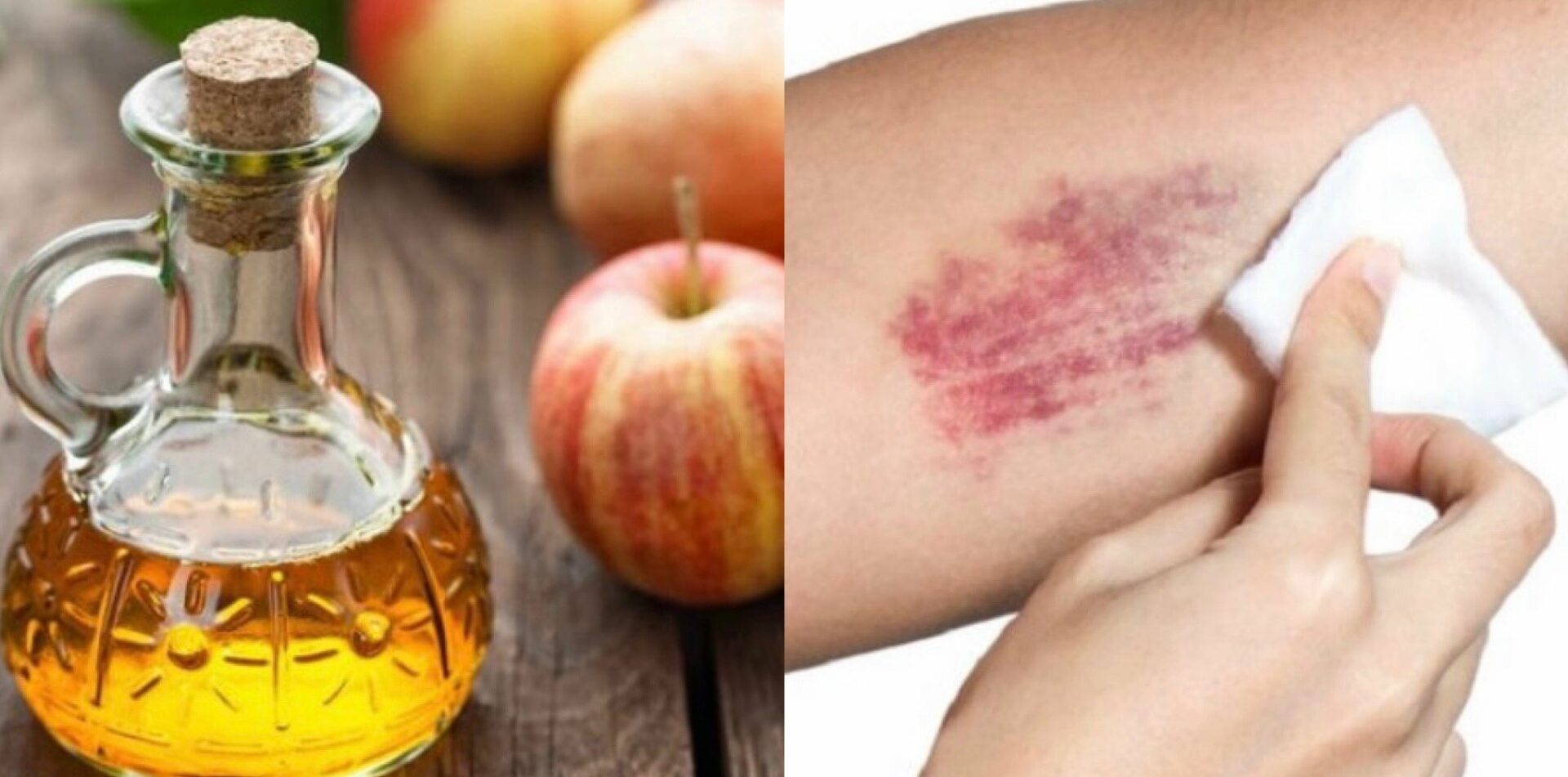 Come Far Sparire I Succhiotti Lividi, ecco i rimedi naturali per farli sparire in breve tempo