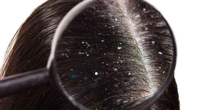 Forfora: cause, sintomi e 10 rimedi naturali efficaci per sconfiggerla